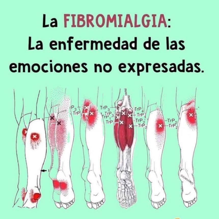 Puntos gatillo en fibromialgia