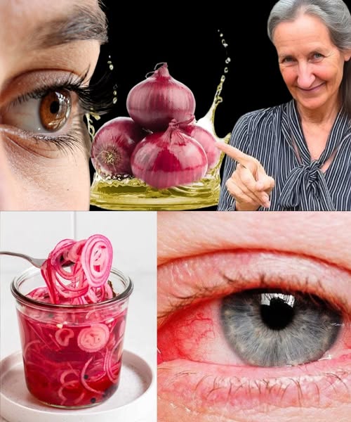 Rodajas de cebolla roja en frasco