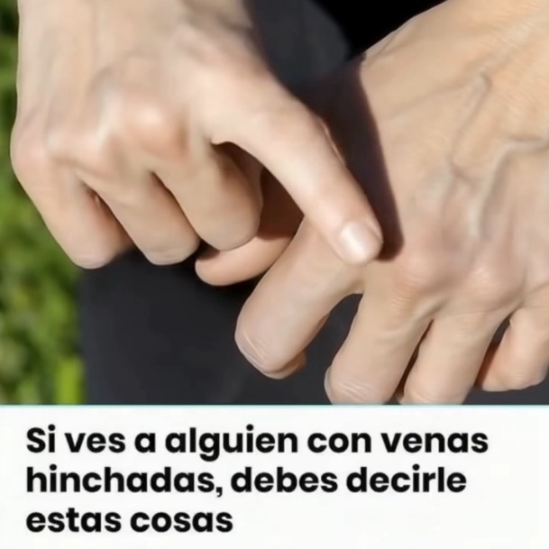 Venas Hinchadas en Manos