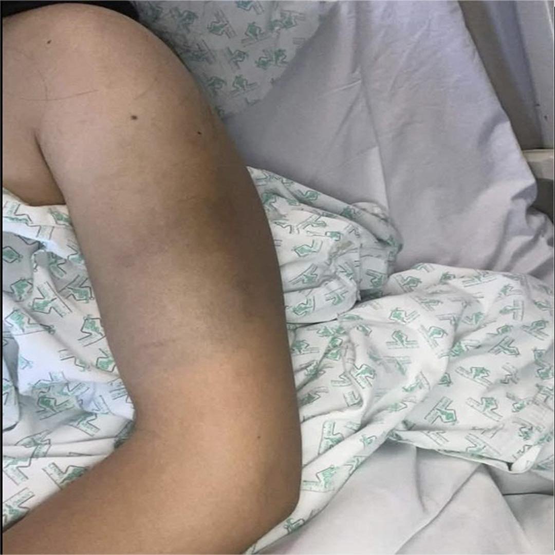 Hematoma en el brazo