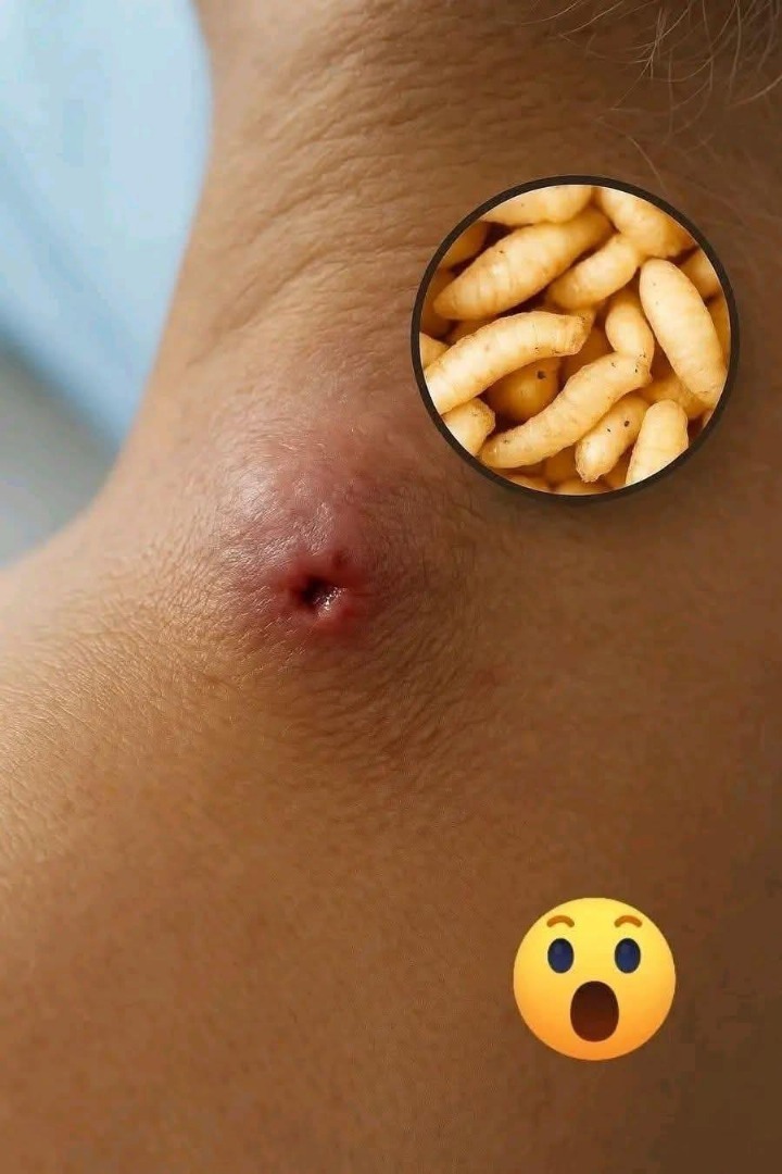 Infestación cutánea por miasis