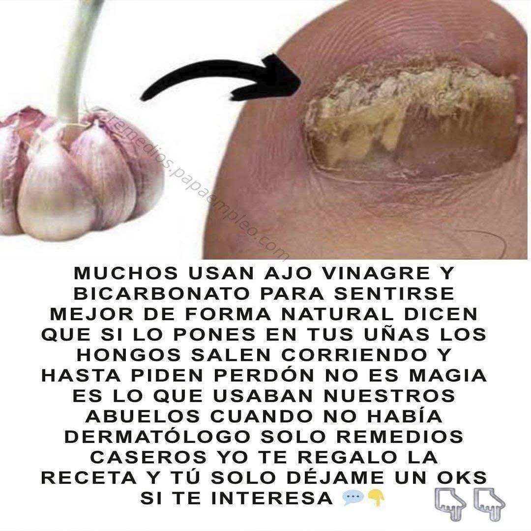 Ajo y un pie con hongos en las uñas
