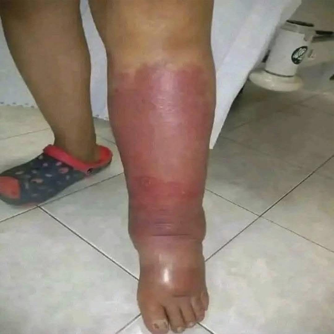 Pierna con enrojecimiento e hinchazón
