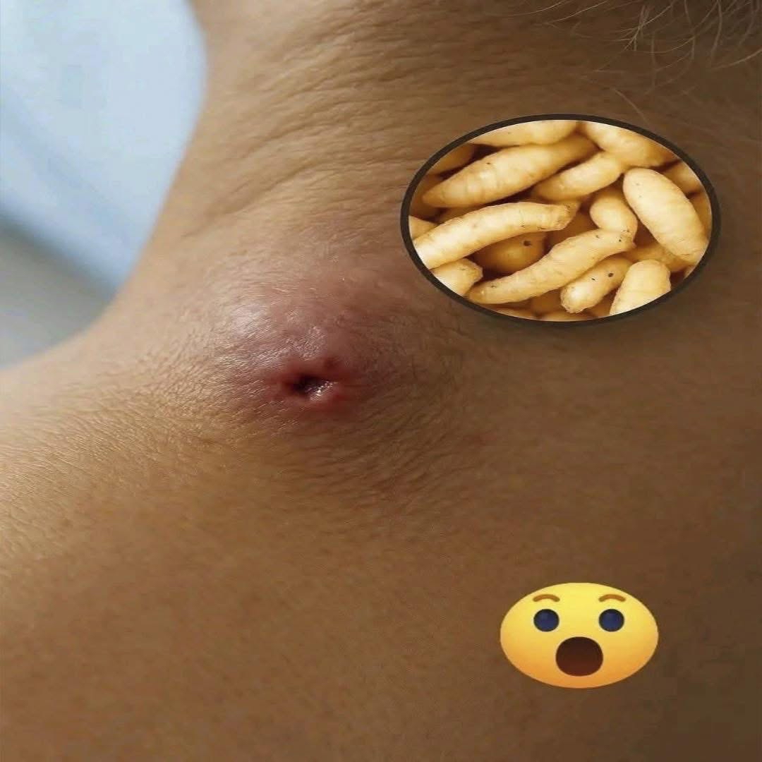 Infestación por larvas