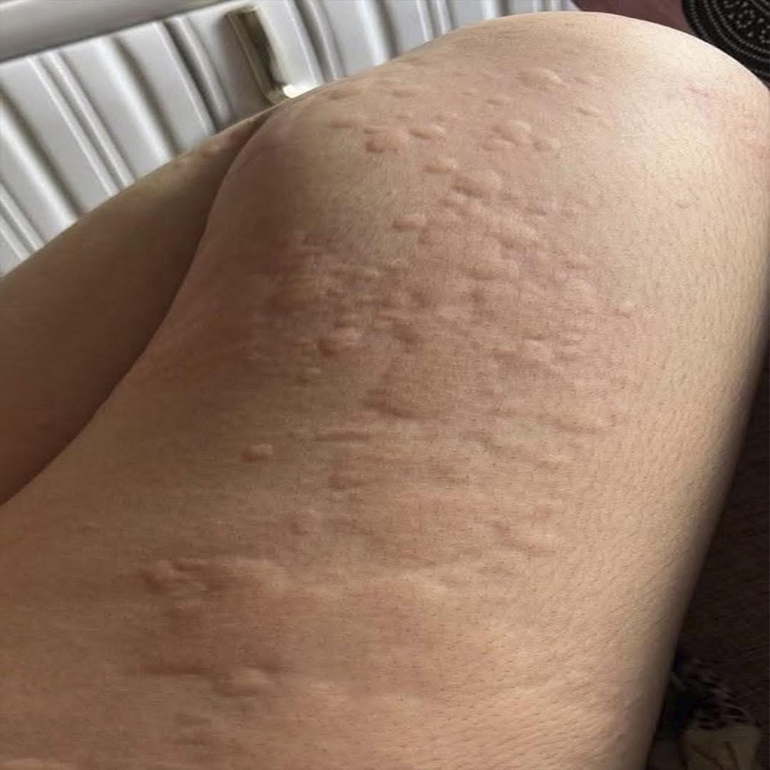 Prototuberancias en la piel