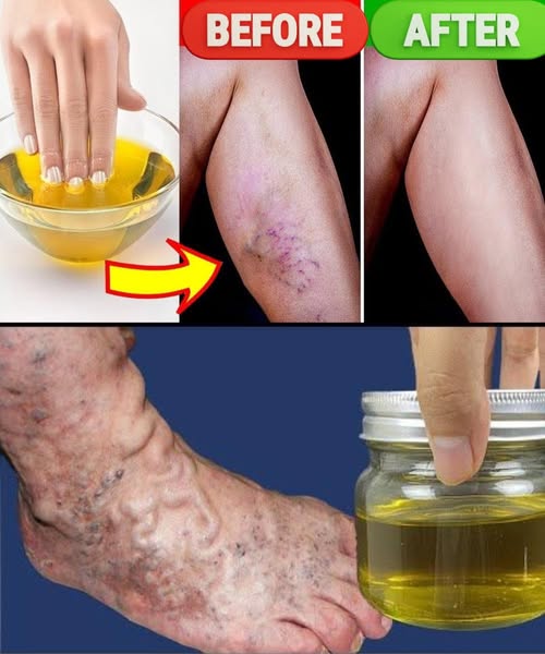 Aceite Natural para Venas Varicosas