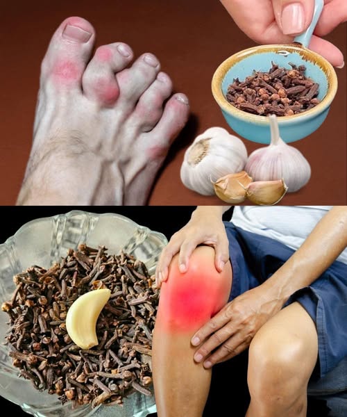Receta de Ajo y Clavos para el Dolor de Piernas