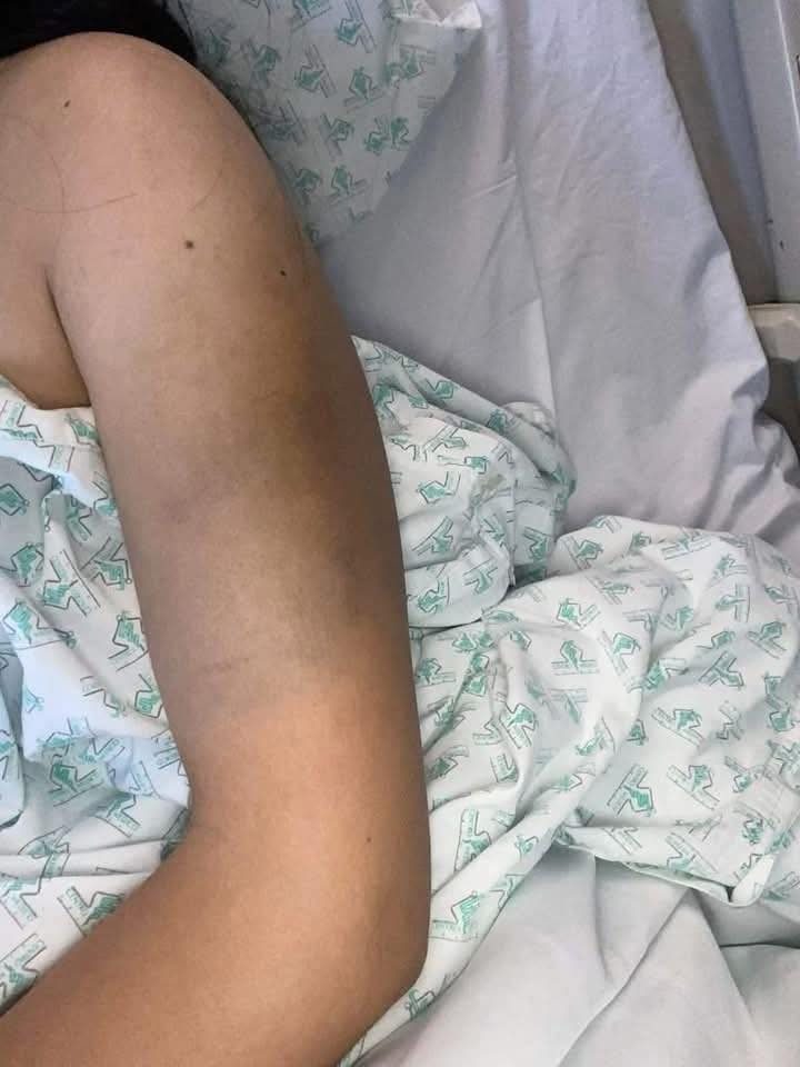 Hematoma visible sobre la piel