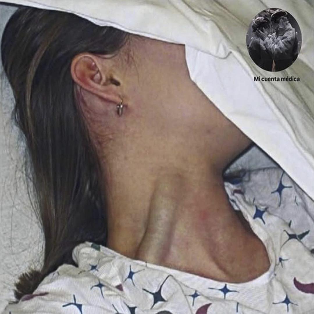 Distensión yugular masiva