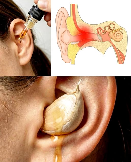 Remedios caseros para el dolor de oído con ajo