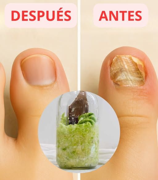 Antes y después de un tratamiento de hongos en las uñas