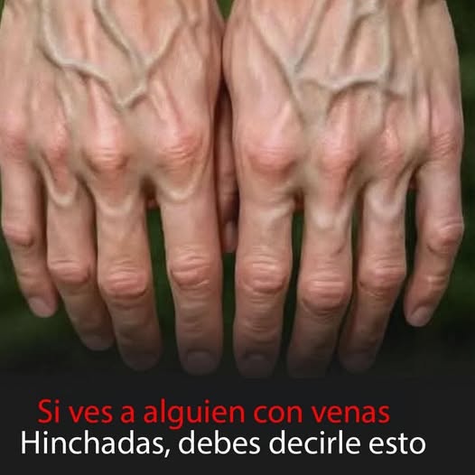 Venas prominentes en manos