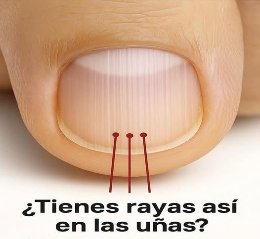 Líneas verticales en uñas