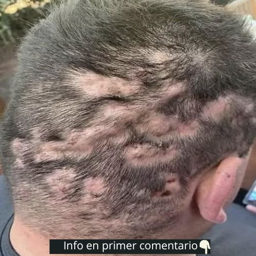 Cuero cabelludo mostrando síntomas de alopecia
