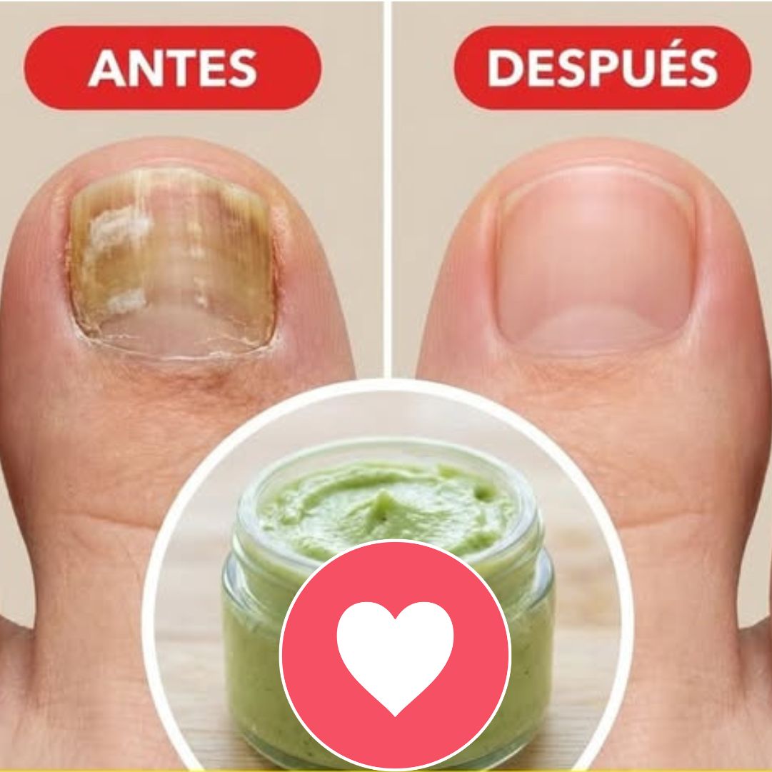 Tratamiento de hongos en los pies